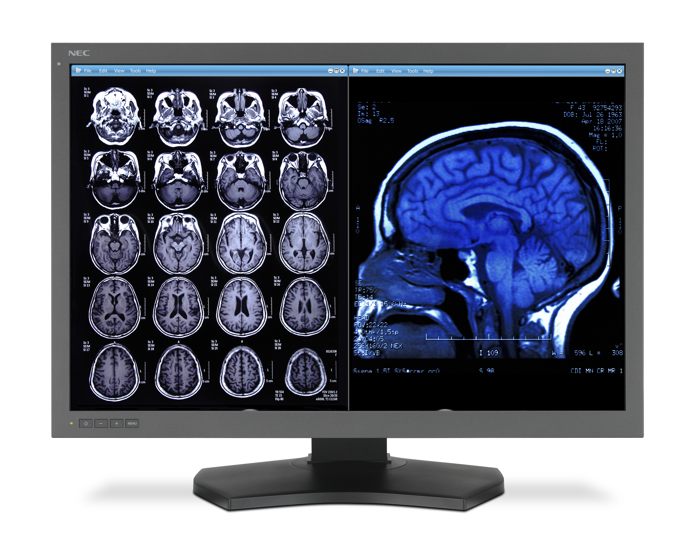 Neuroreader Software Speeds Detection of Brain Volume Changes 